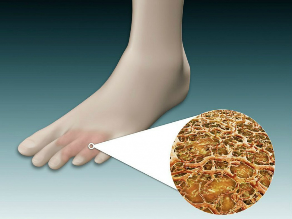 Носки для лечения грибка ног thumbnail